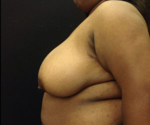 Breast Reduction