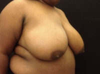 Breast Reduction