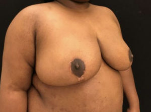 Breast Reduction