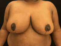 Breast Reduction