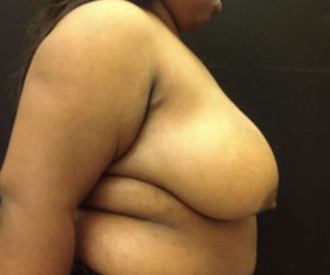 Breast Reduction