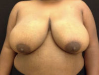 Breast Reduction