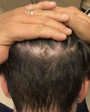 Scalp Reconstruction