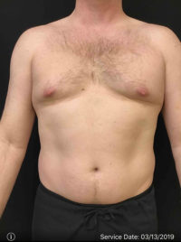 Liposuction