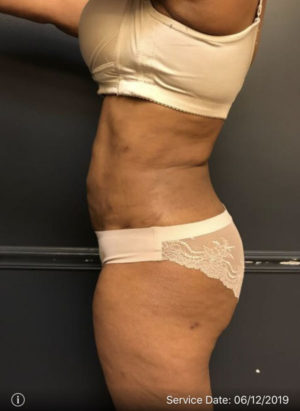 Liposuction