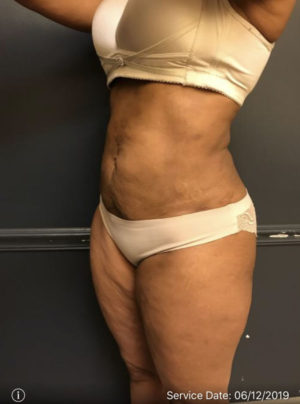 Liposuction