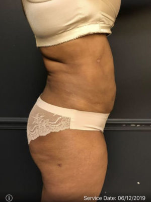 Liposuction