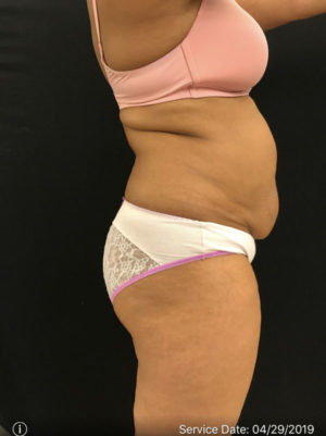 Liposuction