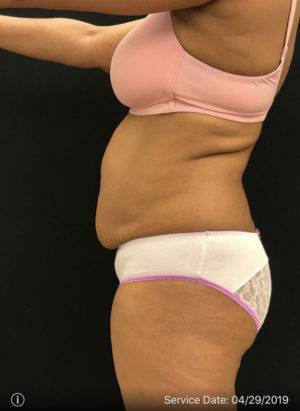 Liposuction