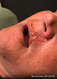 Basal Cell Carcinoma