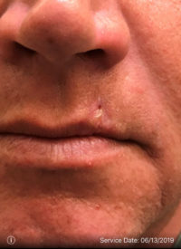 Basal Cell Carcinoma