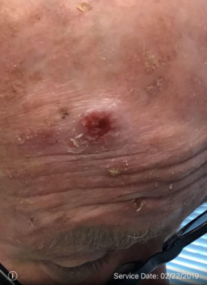 Squamous Cell Carcinoma