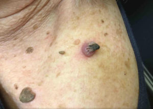 Squamous Cell Carcinoma