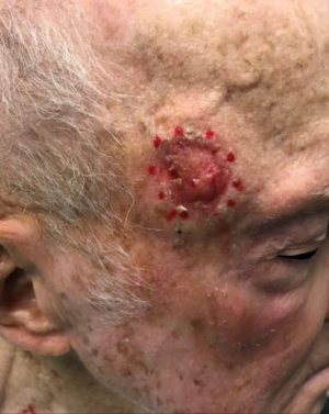 Squamous Cell Carcinoma