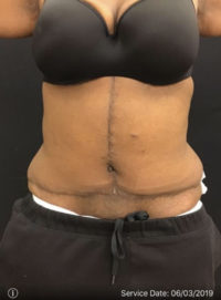 Tummy Tuck