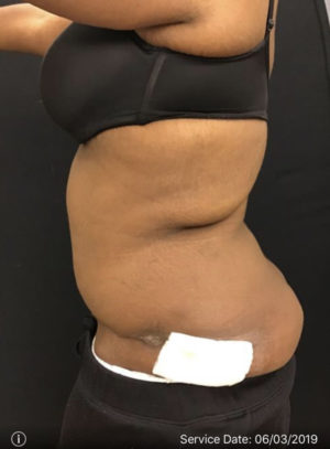 Tummy Tuck