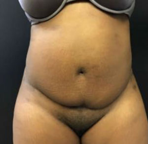 Tummy Tuck