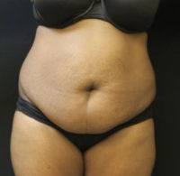 Tummy Tuck