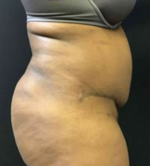 Tummy Tuck