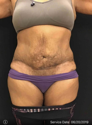 Tummy Tuck