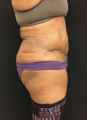 Tummy Tuck