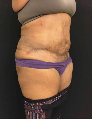 Tummy Tuck