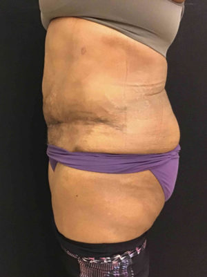 Tummy Tuck