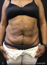 Tummy Tuck