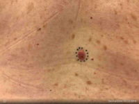 Basal Cell Carcinoma