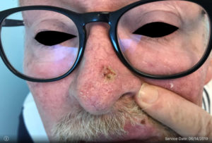 Basal Cell Carcinoma