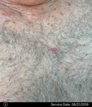 Basal Cell Carcinoma