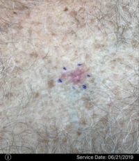 Basal Cell Carcinoma