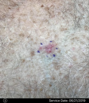 Basal Cell Carcinoma