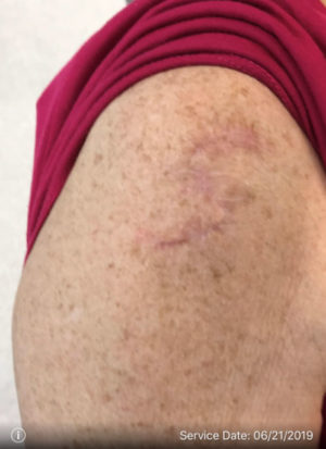 Basal Cell Carcinoma