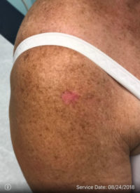 Basal Cell Carcinoma