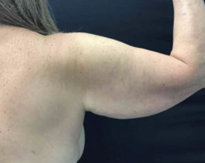 Arm Lift
