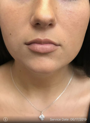 Lip Augmentation