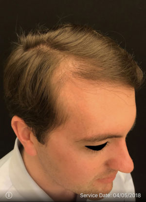 Neograft Hair transplantation