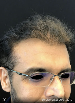 Neograft Hair transplantation