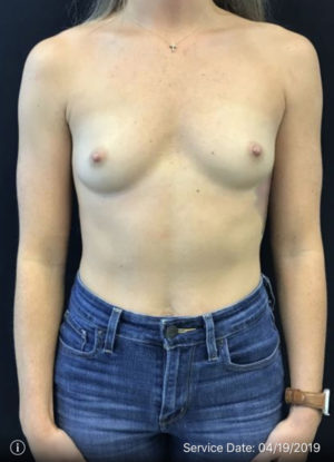 Breast Augmentation