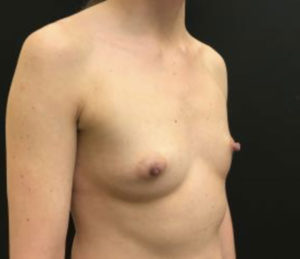 Breast Augmentation