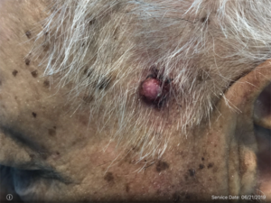 Basal Cell Carcinoma