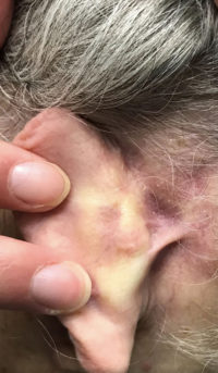 Basal Cell Carcinoma