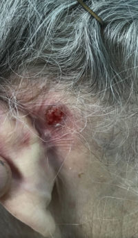 Basal Cell Carcinoma