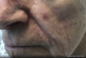 Basal Cell Carcinoma