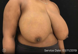 Breast Reduction