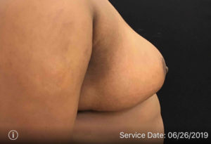 Breast Reduction