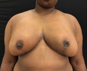 Breast Reduction