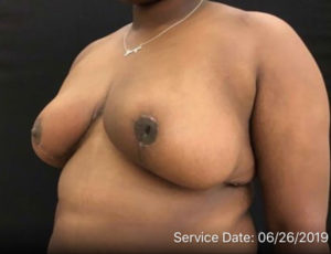 Breast Reduction