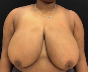 Breast Reduction